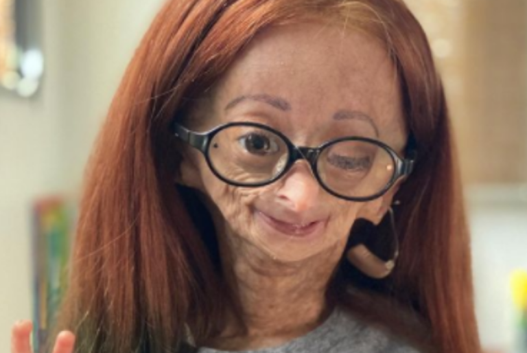 Muere Adalia Rose Williams, youtuber que inspiró la película de Benjamin Button