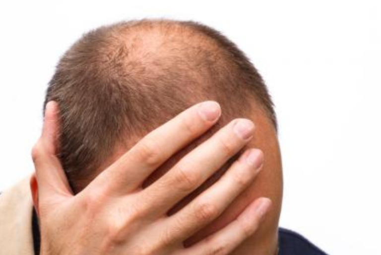 Baricitinib, el primer tratamiento contra la alopecia aprobado por la FDA